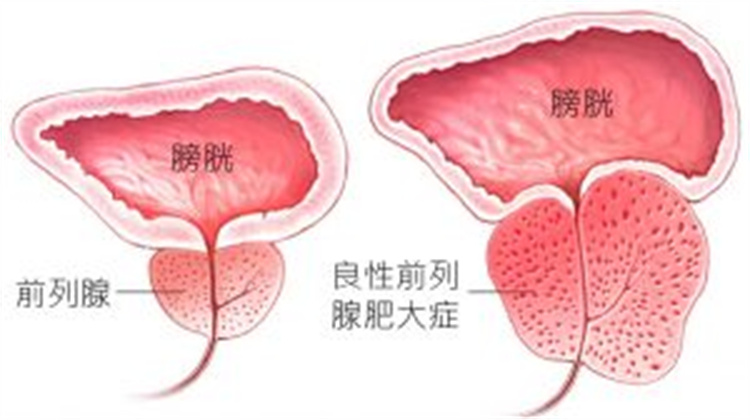 前列腺穴位貼 穴位敷貼 一貼見效、治療陽痿14.jpg